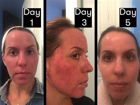 fraxel singapore|Fractional Laser Treatment in Singapore: Before, During & After.